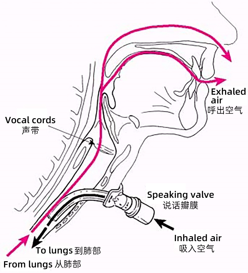 说话瓣膜原理图1